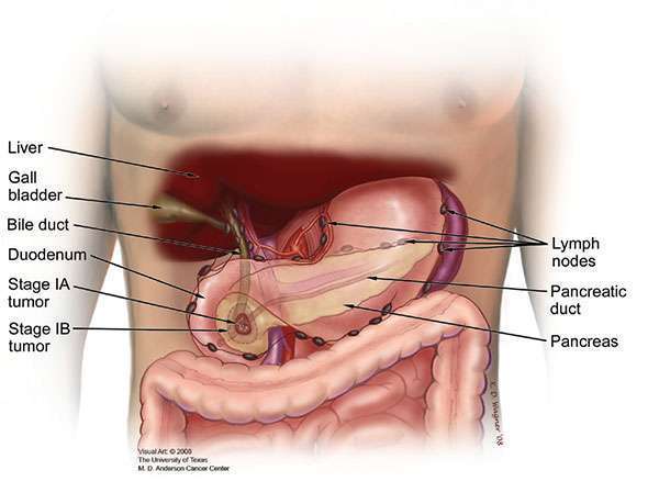 Stage I tumors are limited to the pancreas and can usually be removed by surgery.